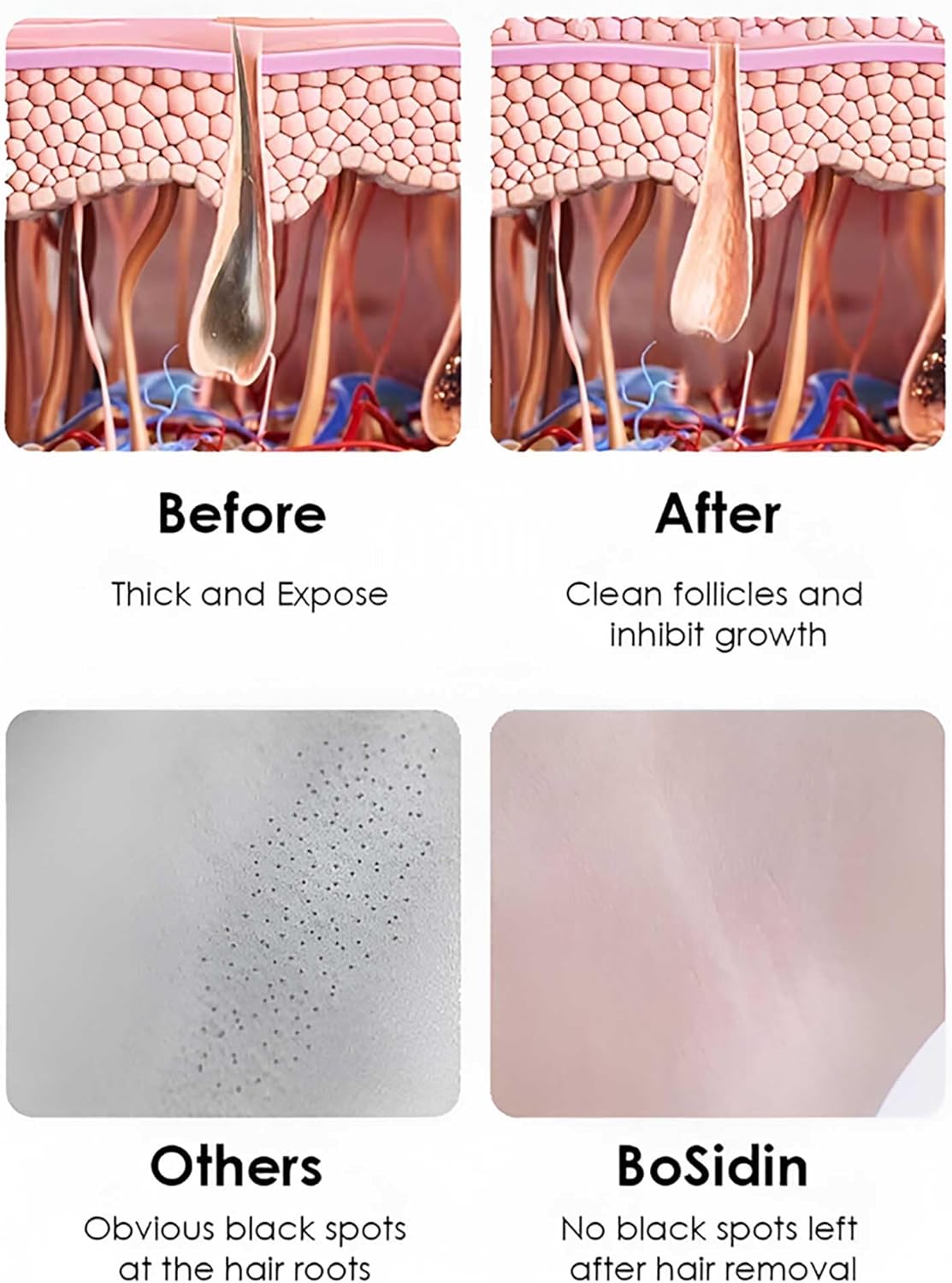 Permanent Laser Hair Removal Machine