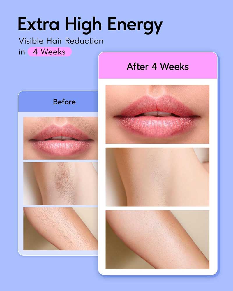 BoSidin Permanent Hair Remover At Home, Upgraded High Energy Levels Laser Hair Removal for Women and Men, 999K Flashes Effective and Safe for Whole Body