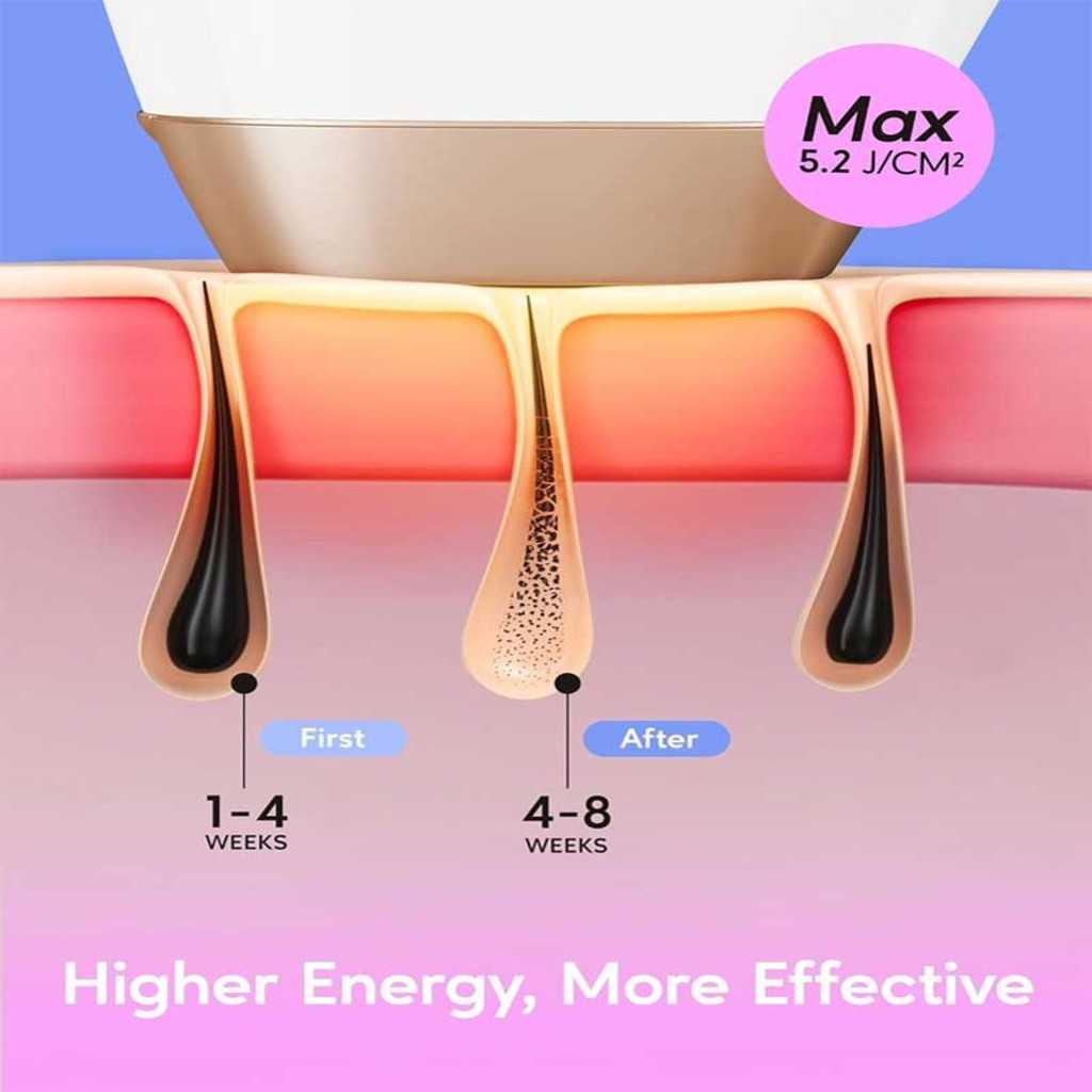 Permanent hair removal at home